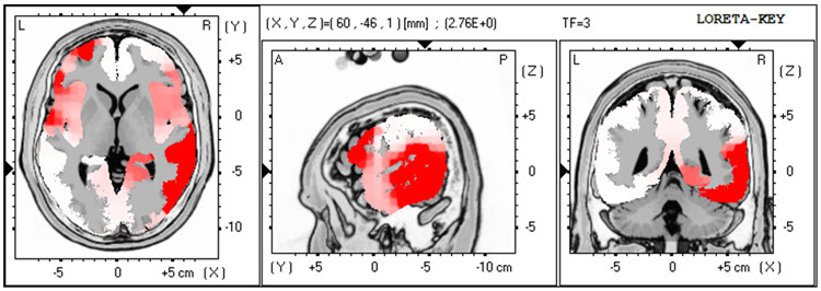 LORETA analysis at 3 Hz showing excess activity exceeding 2 standard deviations
